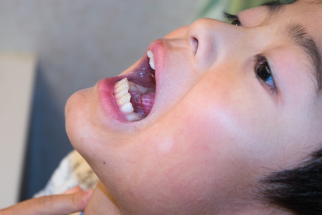 のどの痛み 扁桃腺 子供